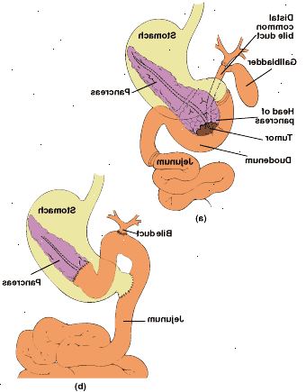 Pylorus bevar pancreaticoduodenectomy: anatomi av resected området (a) og kobles fordøyelseskanalen med ende-til-ende pancreaticojejunostomy (b).